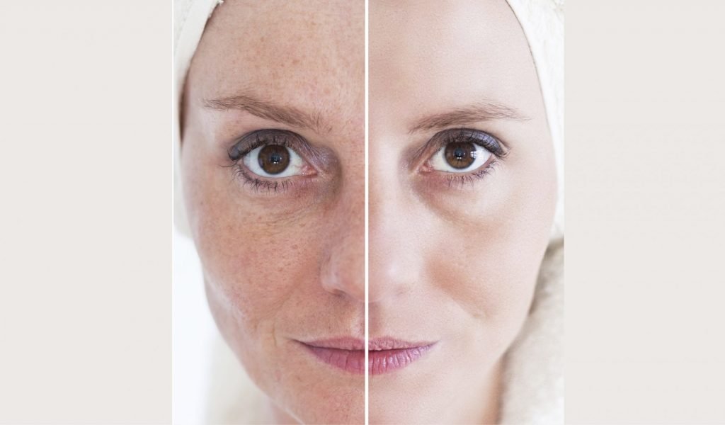 CO2 laser before and after skin resurfacing results