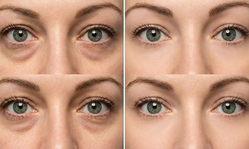 Polynucleotide eye treatment at a premium aesthetic clinic