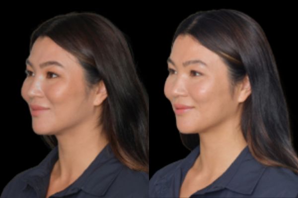Profhilo treatment at a verified aesthetic clinic in Birmingham