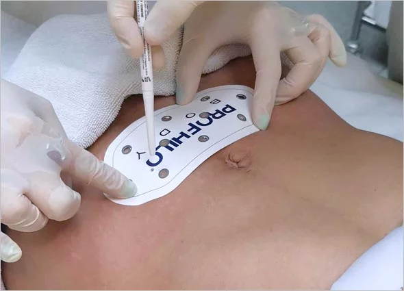 Profhilo Body skin treatment improving firmness and texture on arms abdomen and knees