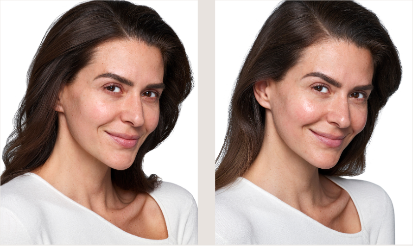 Profhilo treatment at a verified aesthetic clinic in London