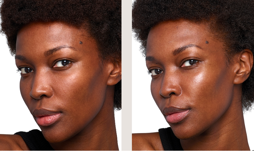 Profhilo treatment at a verified aesthetic clinic in Manchester