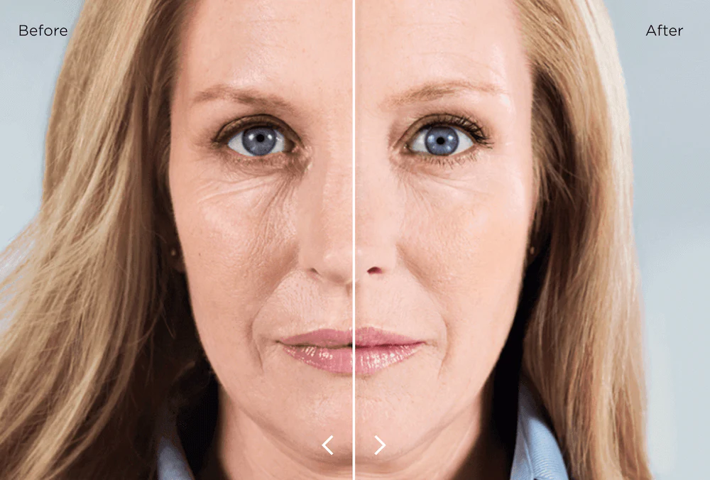 Sculptra before and after results showing gradual facial volume restoration over six months