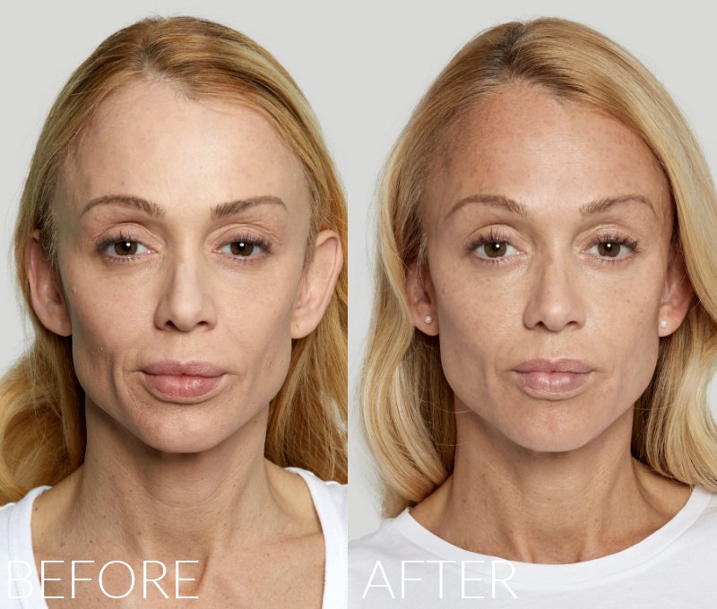 Sculptra treatment at a verified aesthetic clinic in Manchester